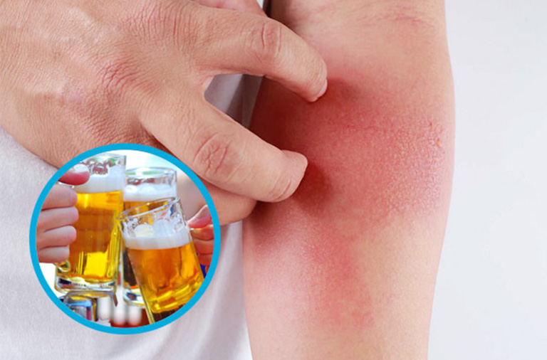 Cách chữa trị khi uống bia rượu bị ngứa